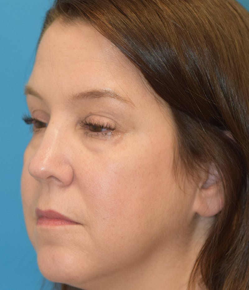 Blepharoplasty Before & After Gallery - Patient 148148045 - Image 3