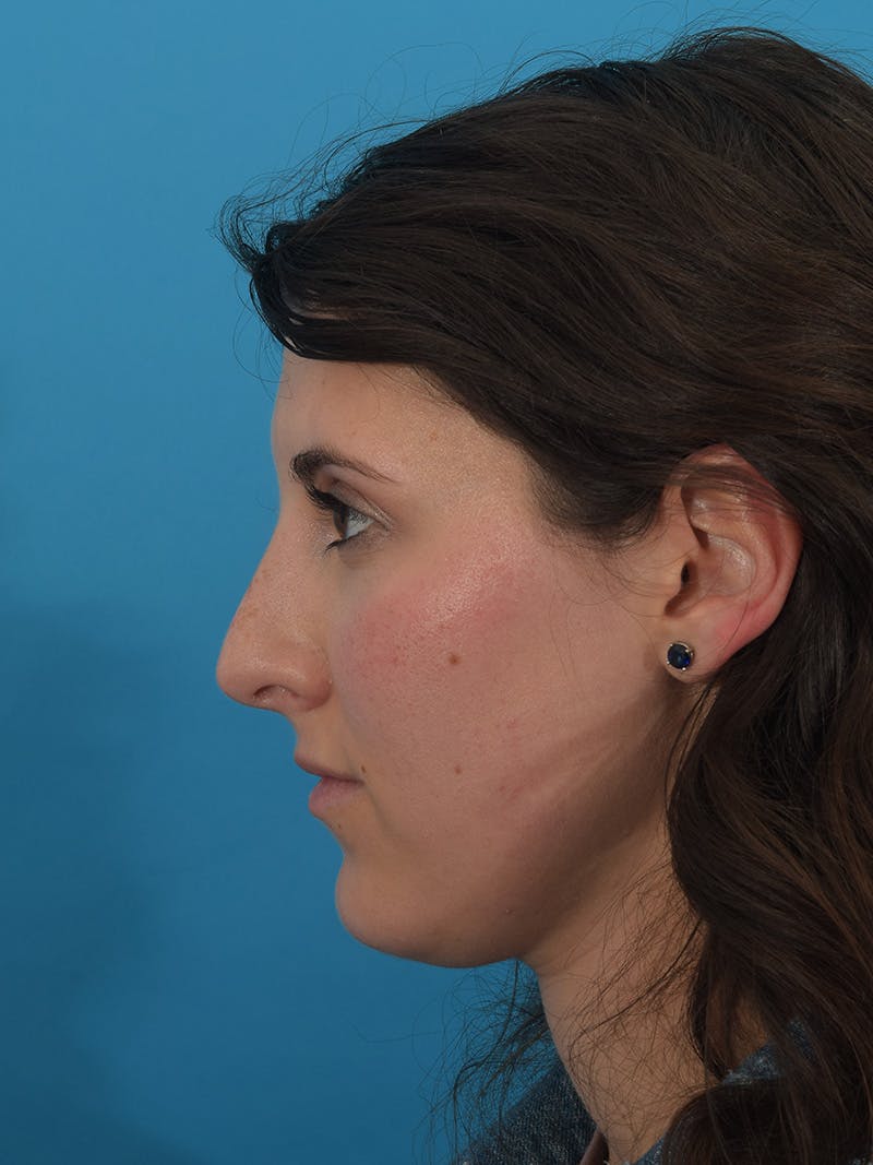 Rhinoplasty Before & After Gallery - Patient 148316767 - Image 1