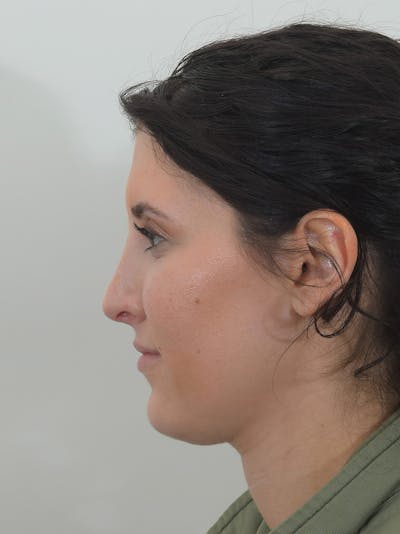 Rhinoplasty Before & After Gallery - Patient 148316767 - Image 2