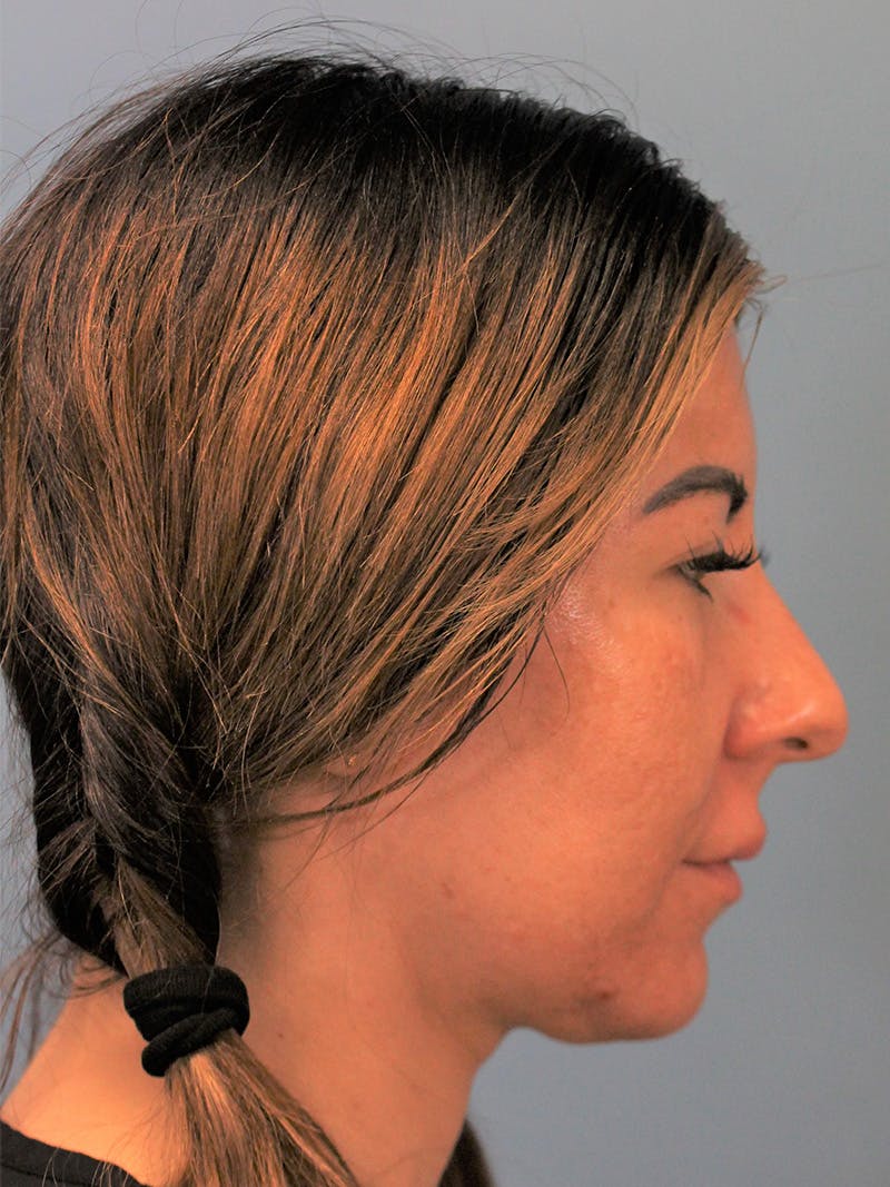 Rhinoplasty Before & After Gallery - Patient 148519247 - Image 1
