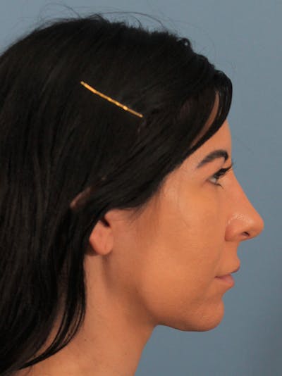 Rhinoplasty Before & After Gallery - Patient 148519247 - Image 2