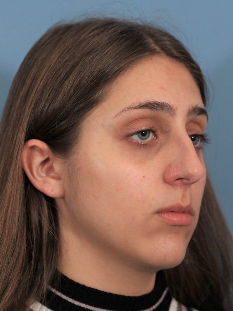 Rhinoplasty Before & After Gallery - Patient 148519291 - Image 5