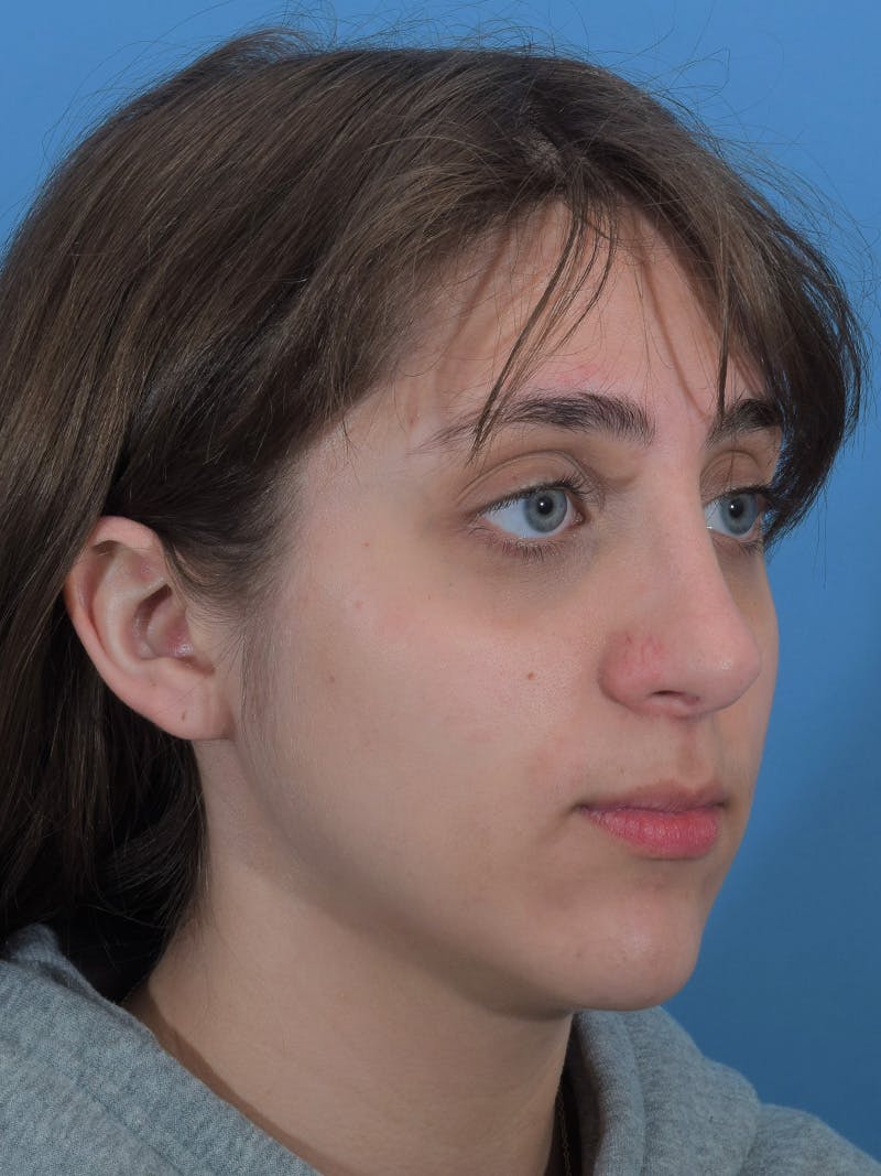 Rhinoplasty Before & After Gallery - Patient 148519291 - Image 6