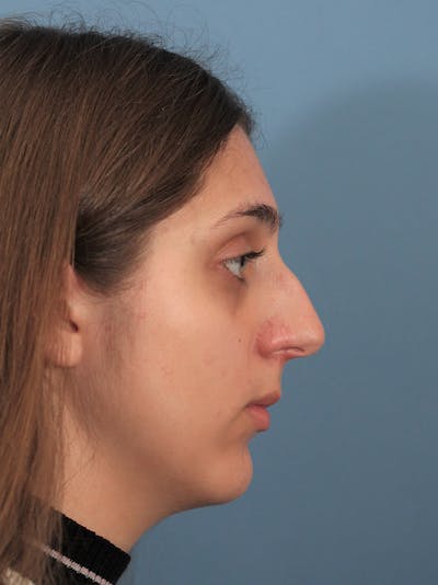 Rhinoplasty Before & After Gallery - Patient 148519291 - Image 1