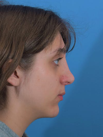 Rhinoplasty Before & After Gallery - Patient 148519291 - Image 2