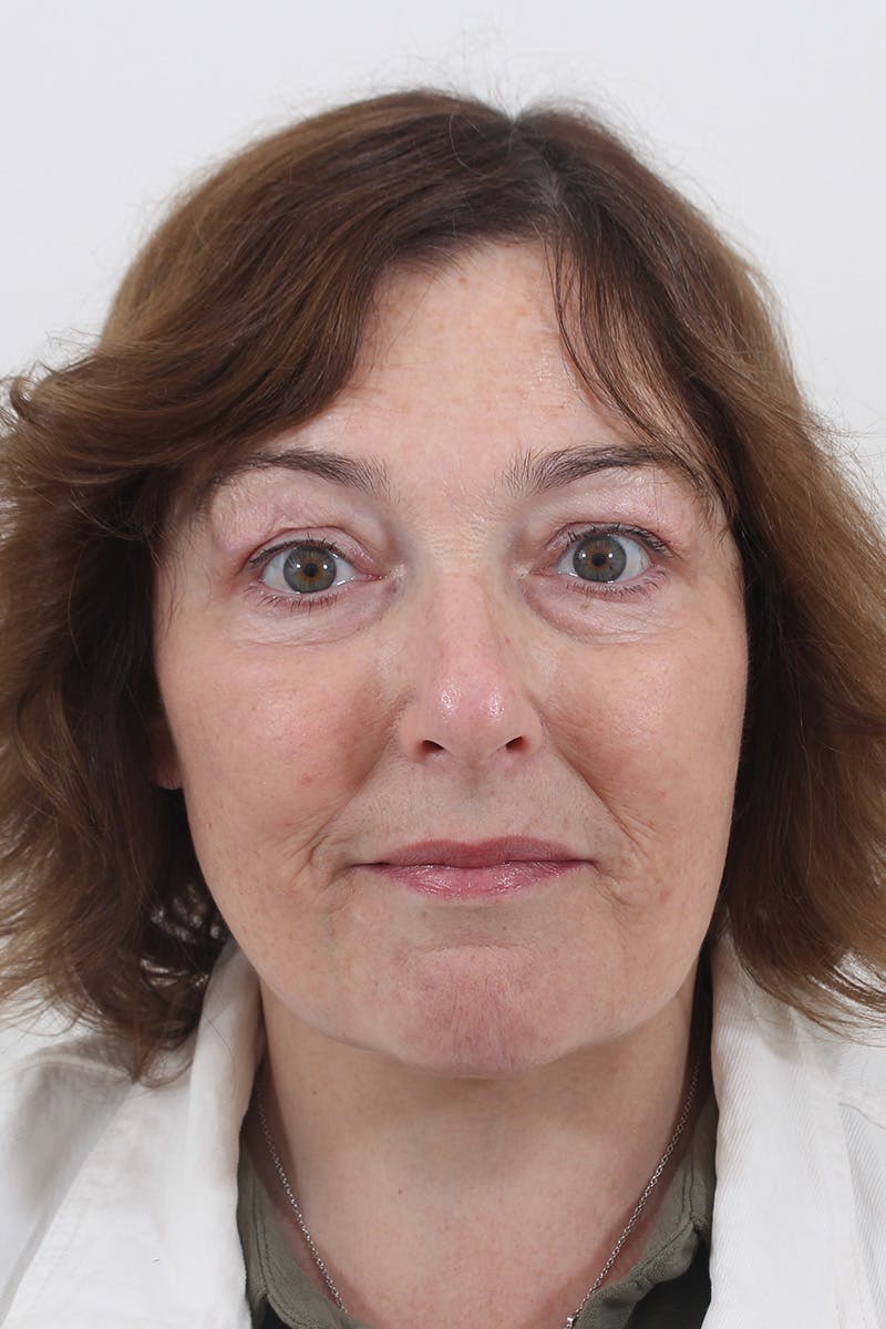Facelift/Neck Lift Before & After Gallery - Patient 148519701 - Image 6