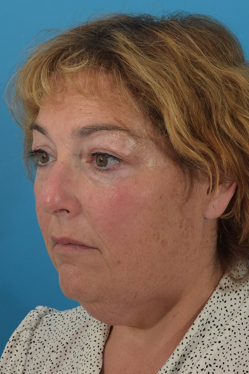 Facelift/Neck Lift Before & After Gallery - Patient 148519701 - Image 5