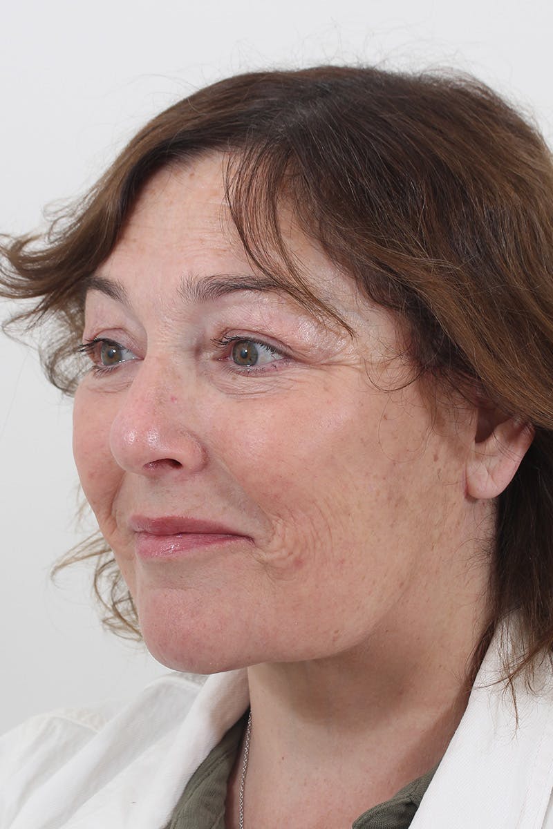 Facelift/Neck Lift Before & After Gallery - Patient 148519701 - Image 6