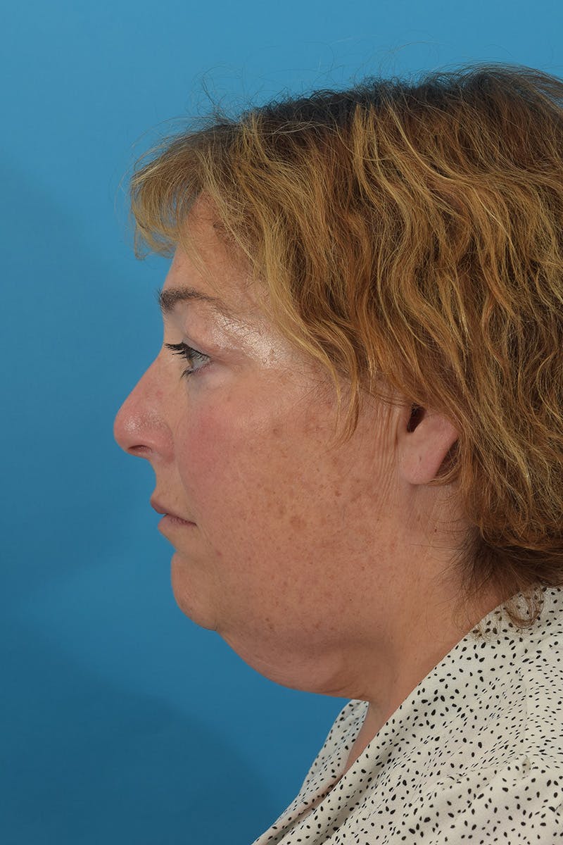 Facelift/Neck Lift Before & After Gallery - Patient 148519701 - Image 3