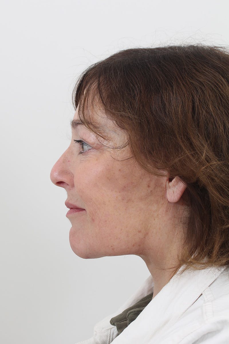 Facelift/Neck Lift Before & After Gallery - Patient 148519701 - Image 4