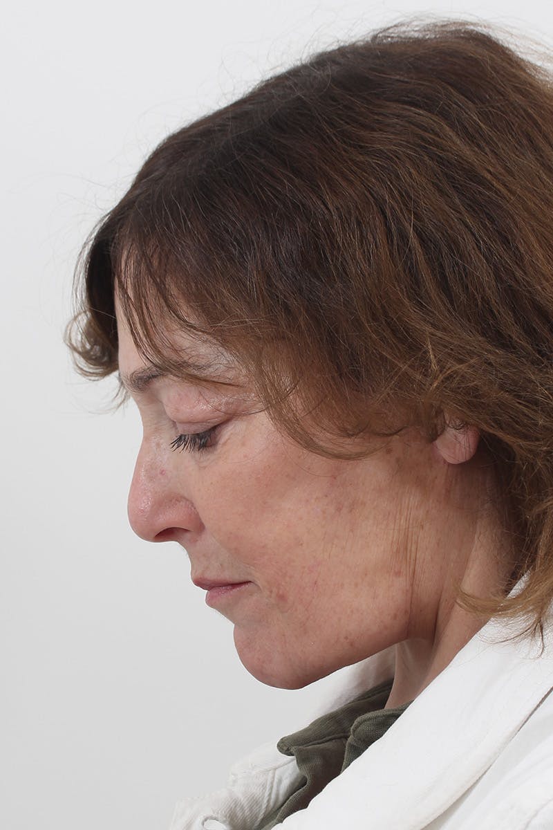 Facelift/Neck Lift Before & After Gallery - Patient 148519701 - Image 8