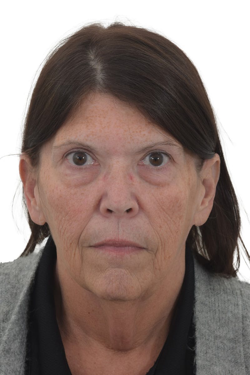 Facelift/Neck Lift Before & After Gallery - Patient 148703213 - Image 3
