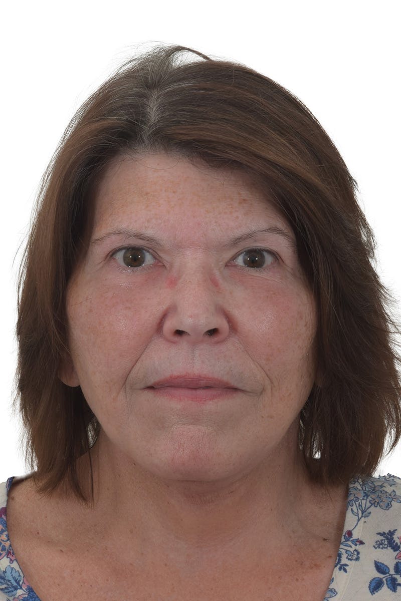 Facelift/Neck Lift Before & After Gallery - Patient 148703213 - Image 4