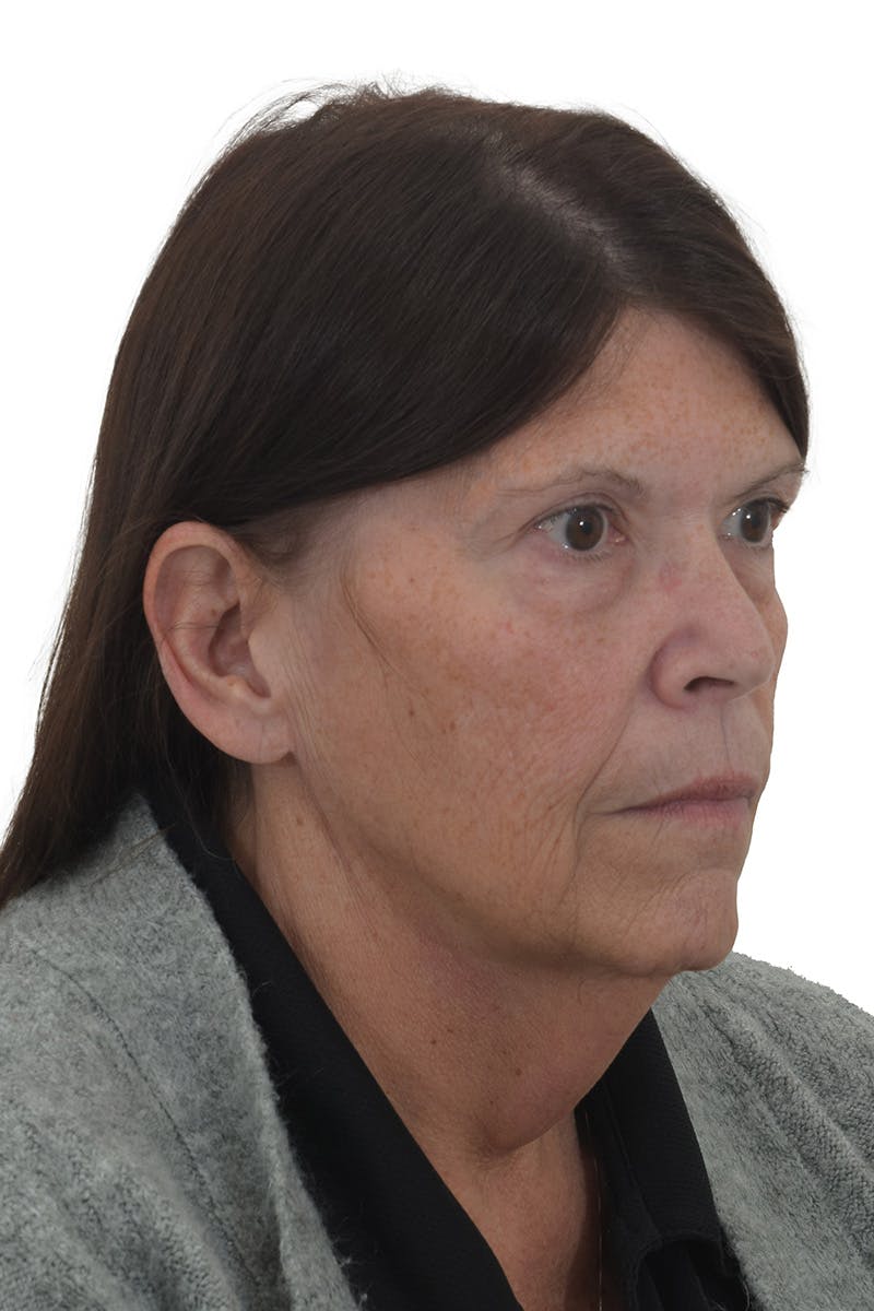 Dr. Frankel’s Facelift in Cleveland Before and After 07