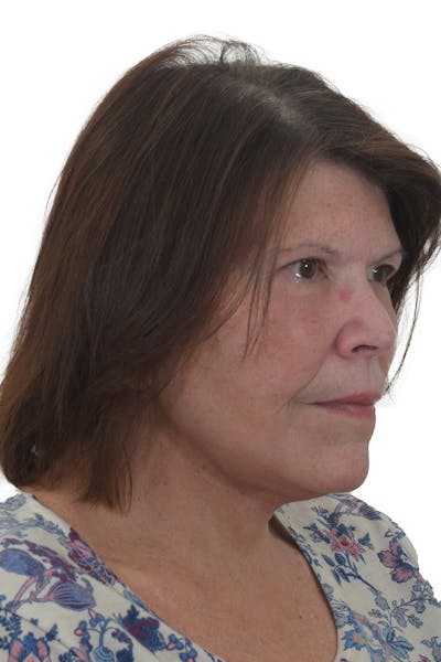 Facelift/Neck Lift Before & After Gallery - Patient 148703213 - Image 2