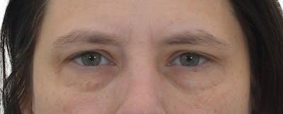 Blepharoplasty Before & After Gallery - Patient 149296850 - Image 1