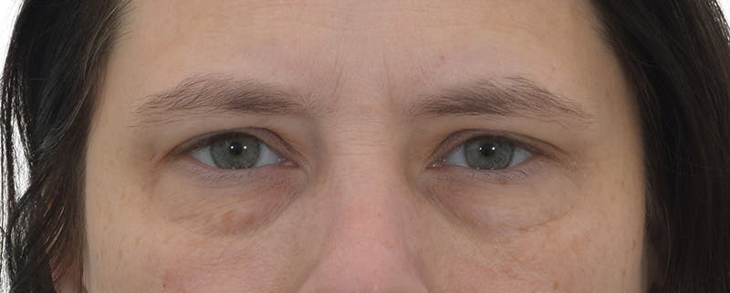 Blepharoplasty Before & After Gallery - Patient 149296850 - Image 1