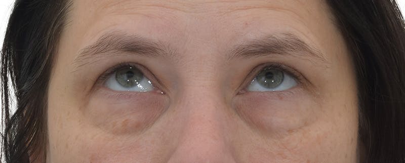 Blepharoplasty Before & After Gallery - Patient 149296850 - Image 3