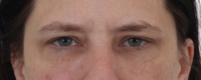 Blepharoplasty Before & After Gallery - Patient 149296850 - Image 2