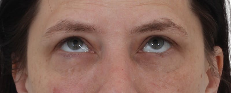 Blepharoplasty Before & After Gallery - Patient 149296850 - Image 4