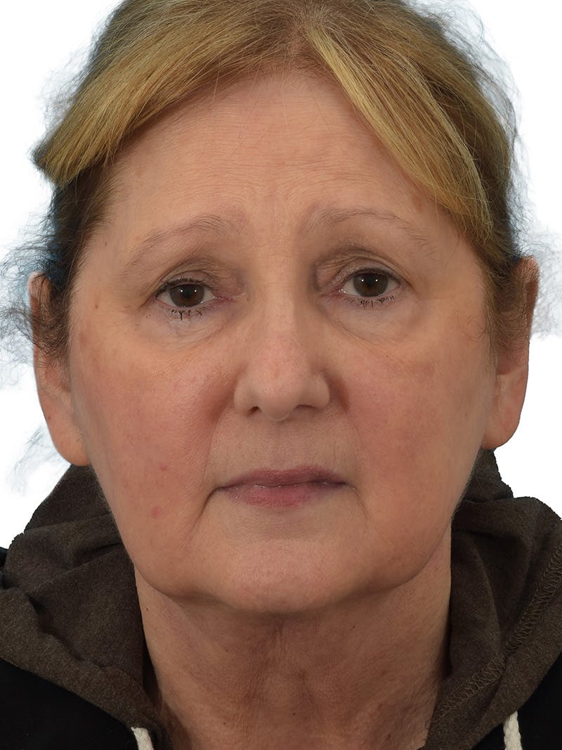 Facelift/Neck Lift Before & After Gallery - Patient 149296872 - Image 3