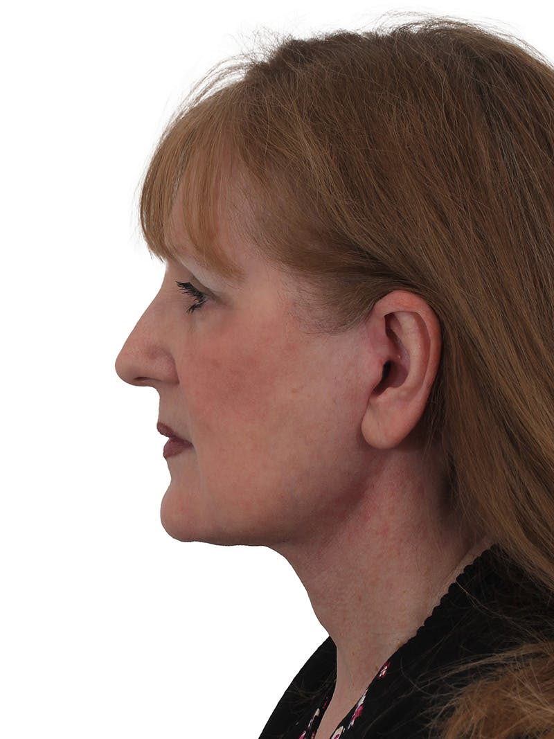 Facelift/Neck Lift Before & After Gallery - Patient 149296872 - Image 6