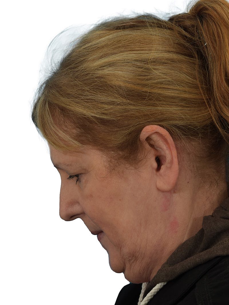 Facelift/Neck Lift Before & After Gallery - Patient 149296872 - Image 7