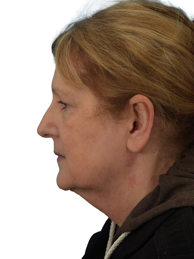 Facelift/Neck Lift Before & After Gallery - Patient 149296872 - Image 5
