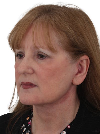 Facelift/Neck Lift Before & After Gallery - Patient 149296872 - Image 2