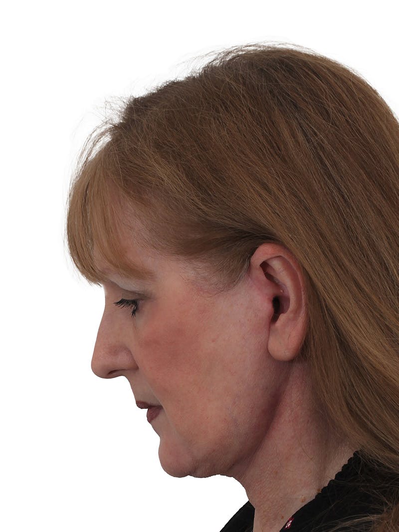 Facelift/Neck Lift Before & After Gallery - Patient 149296872 - Image 8
