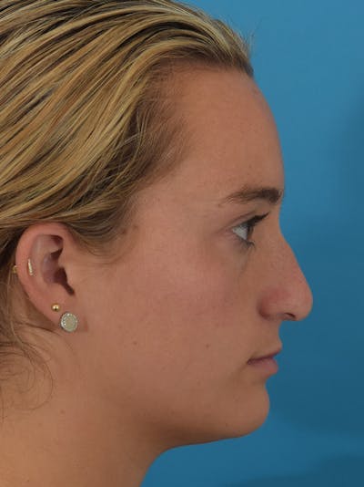 Rhinoplasty Before & After Gallery - Patient 149296860 - Image 1