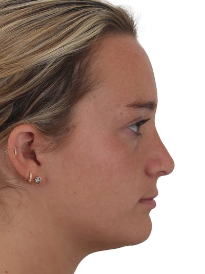Rhinoplasty Before & After Gallery - Patient 149296860 - Image 2