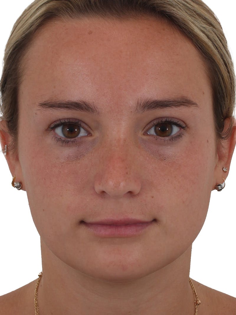 Rhinoplasty Before & After Gallery - Patient 149296860 - Image 6