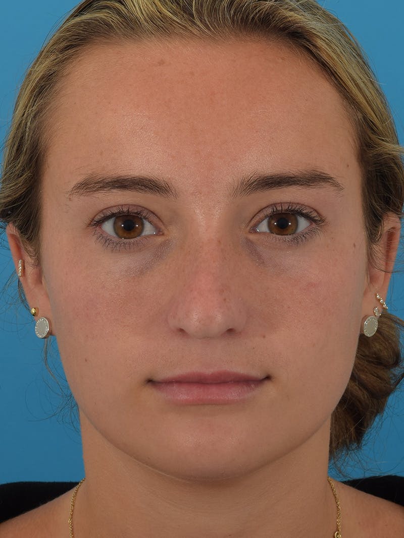 Rhinoplasty Before & After Gallery - Patient 149296860 - Image 5