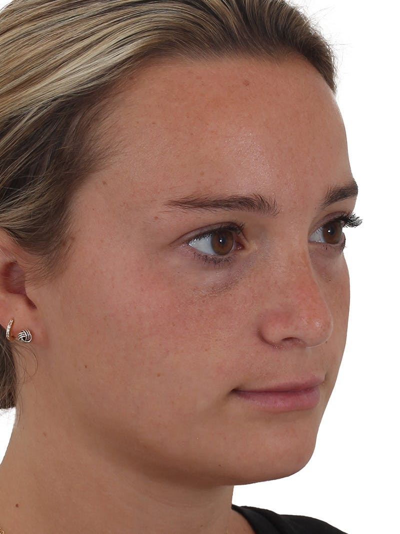 Rhinoplasty Before & After Gallery - Patient 149296860 - Image 4