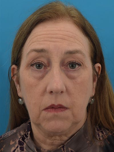 Blepharoplasty Before & After Gallery - Patient 150718072 - Image 1