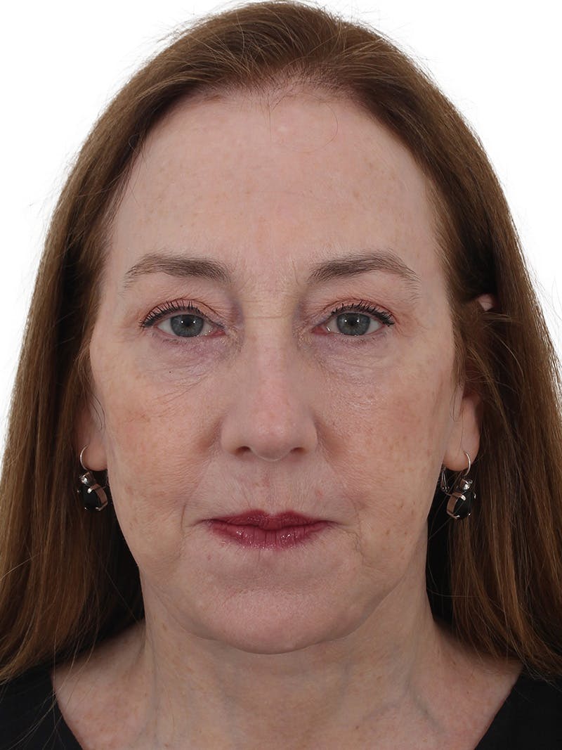 Facelift/Neck Lift Before & After Gallery - Patient 150718075 - Image 4