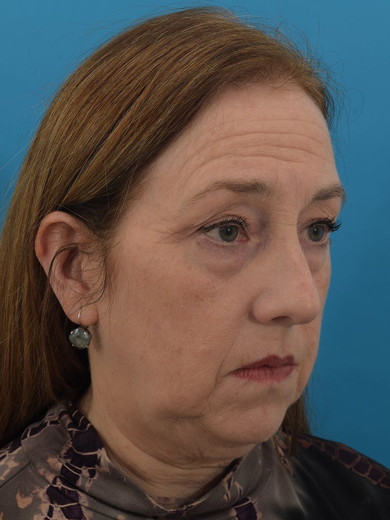 Facelift/Neck Lift Before & After Gallery - Patient 150718075 - Image 3