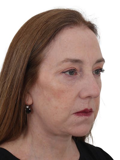 Facelift/Neck Lift Before & After Gallery - Patient 150718075 - Image 2