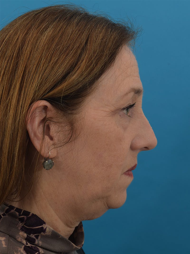 Facelift/Neck Lift Before & After Gallery - Patient 150718075 - Image 5