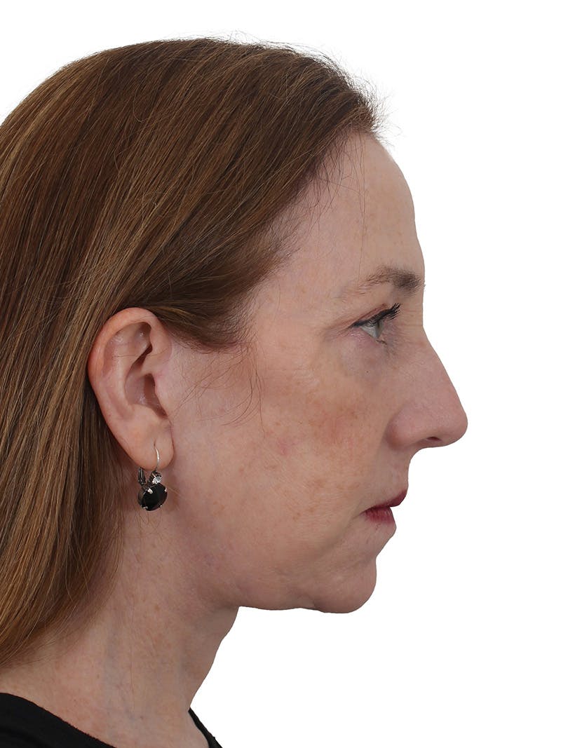 Facelift/Neck Lift Before & After Gallery - Patient 150718075 - Image 6