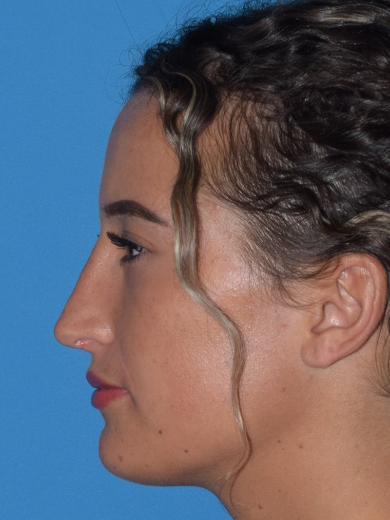 Rhinoplasty Before & After Gallery - Patient 154826230 - Image 4