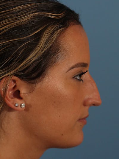 Rhinoplasty Before & After Gallery - Patient 154826230 - Image 1