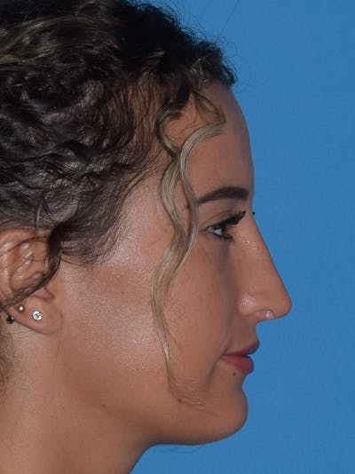 Rhinoplasty Before & After Gallery - Patient 154826230 - Image 2