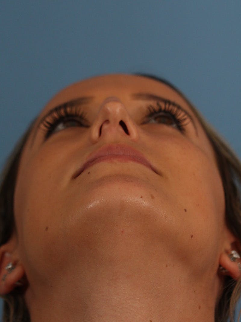 Rhinoplasty Before & After Gallery - Patient 154826230 - Image 7