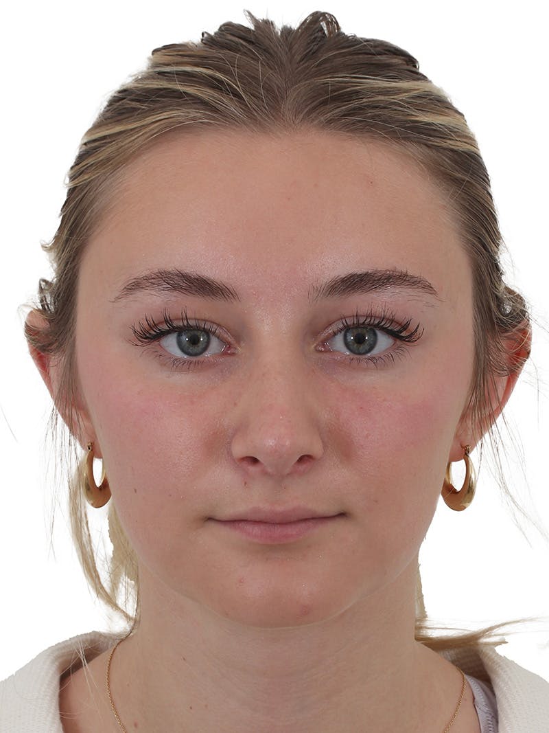 Rhinoplasty Before & After Gallery - Patient 154826229 - Image 4