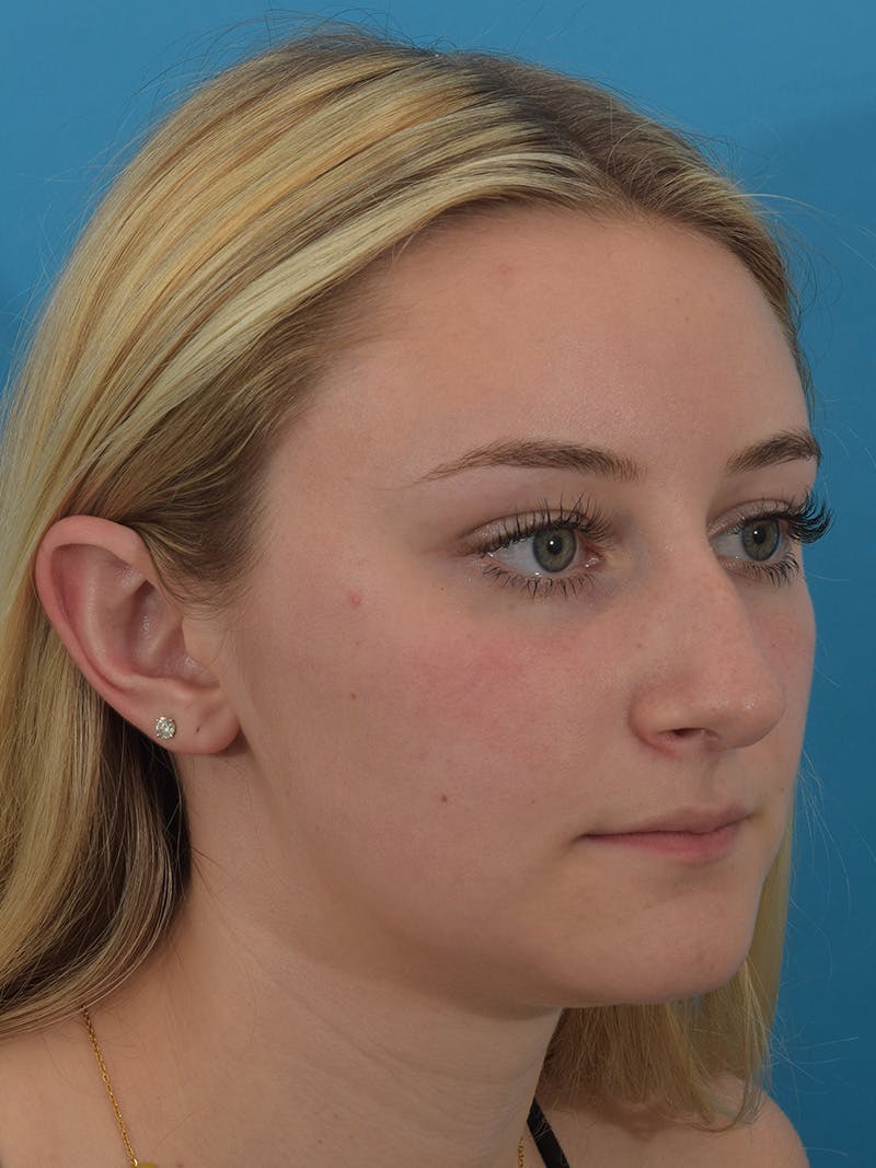 Rhinoplasty Before & After Gallery - Patient 154826229 - Image 5