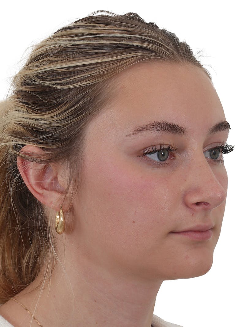 Rhinoplasty Before & After Gallery - Patient 154826229 - Image 6