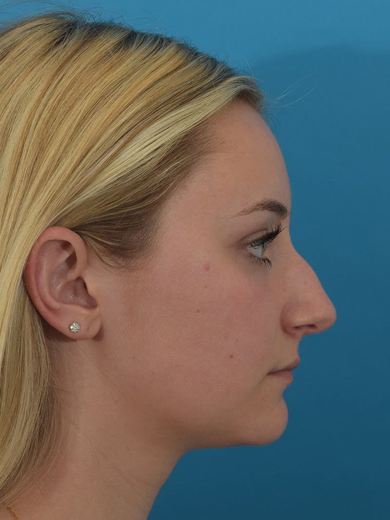 Rhinoplasty Before & After Gallery - Patient 154826229 - Image 1