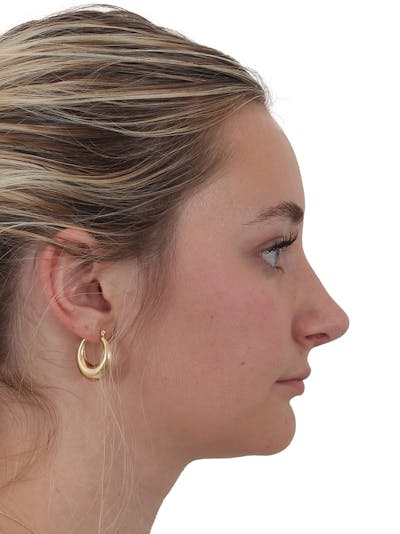 Rhinoplasty Before & After Gallery - Patient 154826229 - Image 2